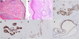 Images from the pathological study: A) Ductal carcinoma in situ associated with epidermis with sieve-like formation and comedo necrosis (hematoxylin-eosin [H-E] ×2); B) Ductal carcinoma in situ with presence of pagetoid extension (H-E, ×20); C) Positive immunostaining for CK20 (×10); D) Positive immunostaining for CK7 (×4); E) Positive immunostaining for estrogen receptor (×10); F) Positive immunostaining for progesterone receptor (×20).