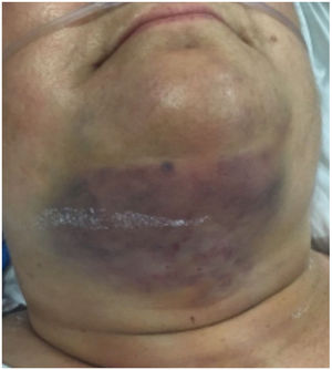 Superficial cervical hematoma (trocar bleeding).
