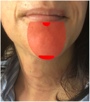 Transient palsy of the mental region: the shaded area shows the initial area of presentation, while the 2 solid areas had longer-lasting palsy (midline of the lower lip and the tip of the chin).