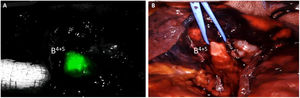 A) Visualization and identification of segmental bronchi B4+5 with the Firefly system of the daVinci® robot after insertion of the bronchoscope through the endotracheal tube, with no administration of fluorescent color; B) Endoscopic view after dissection of the B4+5 bronchus.