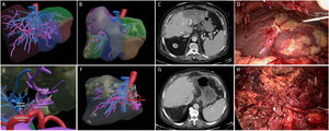 Preoperative surgical planning of 3D virtual reconstruction (A). 3D virtual reconstruction of liver ischaemia (B). CT scan after liver transplantation with ischaemia of the left hepatic lobe and signs of necrosis in segments 2–3 (C). Intraoperative findings (D). 3D virtual reconstruction of thrombosis of the left hepatic artery and branch of section 4 (E). 3D virtual reconstruction of the graft after laparoscopic liver resection (F). CT scan on postoperative day 5 after laparoscopic liver resection. The graft is adequately perfused with a small region of hypoperfusion in the vicinity of the resection margin (G). Intraoperative findings of the liver graft after laparoscopic hepatectomy (H).