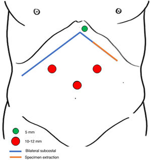 Representative schematic of the bilateral subcostal incision (blue line) used for transplantation. The specimen was removed through the left lateral margin of this incision (orange line). Representation of trocar placement.