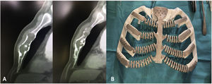 Preoperative high resolution chest tomography showed an osteolytic lesion of the sclerotic edges, with cortical rupture, without emptying of soft tissues, causing insufflation of the sternal body (A). Prosthesis made and supported on a 3D copy of the patient's wall (B).