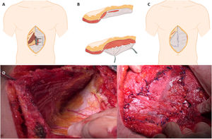 A) Detail of the extraction of the posterior rectal sheath. B) Enlargement of the dissection in the posterior rectal sheath for flap extraction. C) Implantation of the flap in the upper defect. D) Dissection of the posterior rectal sheath in the patient. E) Re-implantation of the posterior sheath in the defect.