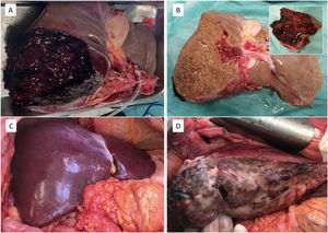 (A) Graft appearance after harvesting; (B) graft appearance after bench reduction; (C) graft appearance after reperfusion (anterior aspect); (D) graft appearance after reperfusion (posterior aspect).