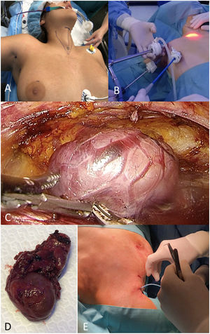 (A) Position of the patient and anatomical references. (B) Position of the trocars. (C) Intraoperative surgical space and visualisation of thyroid structures. (D) Extraction of the surgical specimen. (E) Placement of surgical drain.