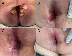 Perianal ulcers at first consultation (A), 4 (B), 6 (C), and 8 (D) weeks after discontinuation of treatment with antihaemorrhoid cream.