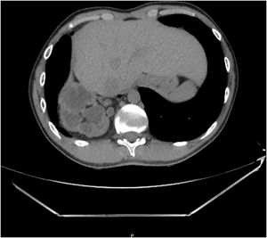CT-Scan: right diaphragmatic defect. Intrathoracic grade III–IV hydronephrotic right kidney.
