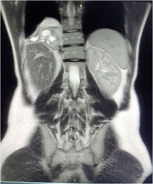 MRI: right diaphragmatic defect. Intrathoracic grade III–IV hydronephrotic right kidney due to ureteral involvement at the hernial orifice.