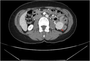 Abdominal contrast-enhanced computed tomography: 32 × 32 × 34 mm homogeneus hypervascular well-defined solid tumor with a small central hypodensity (red arrow) located in the intraperitoneal left posterior abdominal void, with an apparent intraperitoneal location. The dependency organ is not defined, only broad contact is seen with adjacent intestinal loops but without thickening or stenosing them.