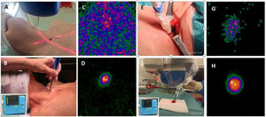Radioguided surgical technique. Cutaneous localization of the most direct access using a portable gamma camera (A) and gamma detector probe (B). In vivo image with portable camera of the lesion marked with MIBI (C) and MAA (D). Radioguided dissection (E) and excision of the parathyroid adenoma, confirmed ex vivo with the probe (F). Adenoma ex vivo images of MIBI (G) and MAA (H).