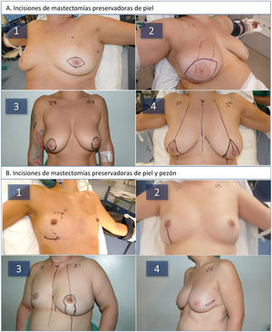 A: Types of skin-sparing mastectomies (SSM) used during the study: periareolar spindle-shaped (1), central spindle-shaped (2), tabaco pouch (3), Carlson type 4 inverted T pattern (4). B: Types of skin- and nipple-sparing mastectomies (SNSM) used during the study: inframammary fold (1), inferior vertical (2), vertical pattern (3), lateral (4).
