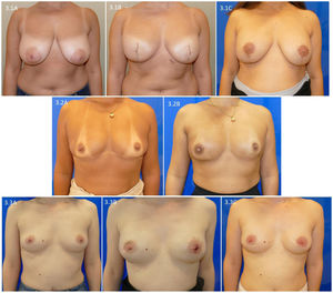 Evolution one year after surgery in patients with a skin-sparing mastectomy and prepectoral reconstruction: 3.1) patient with a type iv skin-saving mastectomy; 3.1C) evolution after reconstruction of the nipple and areola tattoo; 3.2A) patient with invasive carcinoma of the right breast with indication for chest wall radiation therapy; 3.2B) evolution one year after radiation therapy of the right chest wall; 3.3A) patient with extensive ductal carcinoma of the right breast; 3.3B) deformity of the right NAC after extension of the retroareolar superficial margin of the right breast; 3.3C) evolution one year after surgery.