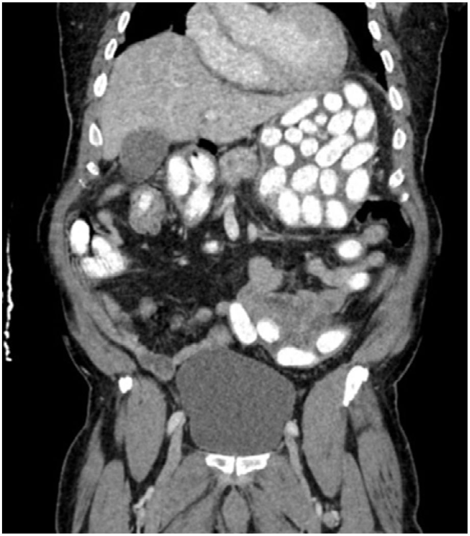 Bodypacker’s syndrome | Cirugía Española (English Edition)