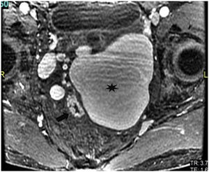 Pelvic MRI in axial section with LAVA sequence. The rectum (arrow) and the adjacent rectal varicose vein (asterisk) are visualised.