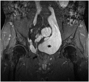 Pelvic MRI in coronal section with LAVA sequence. The collapsed rectum (arrow) and adjacent rectal varicose vein (asterisk) are visualised.