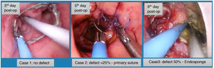 Clinical cases and transanal management depending on the findings of the transanal revision.