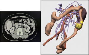 Abdominal-pelvic axial CT image and 3D reconstruction based on the same CT 1) Tumor; 2) Lymphadenopathy in the region of the inferior mesenteric vein; 3) Spleen.