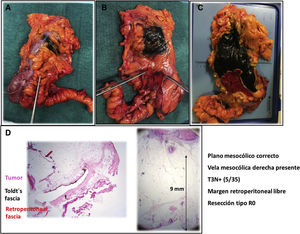 Pathological study of the surgical specimen: A) Anterior view with tattoo of the tumor margin by endoscopy; B) Posterior view of the surgical specimen with retroperitoneal fascia indicated by the surgeon; C) Posterior view of the surgical specimen with retroperitoneal margin marked with black India ink and retroperitoneal fascia marked with red India ink; C) Microscopic vision of the relationship of the tumor with the retroperitoneal fascia and the tumor distance to the retroperitoneal margin; 1) Retroperitoneal fascia.