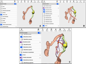 3D-IPR method used to establish surgical strategy in neoplasm of the splenic flexure: A) Mathematical delimitation of the intestinal margin 10 cm proximal and distal to the tumor; B) Feeder vessels of the area established in A/C; Location of possible lymphadenopathies in the arterial and venous region of the area established in A.