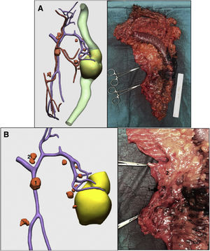 Comparison of the surgical specimen simulated by 3D-IPR and actual surgical specimen: A) Complete surgical specimen; B) Surgical specimen of the region of the inferior mesenteric vein; 1 and 2) Possible lymphadenopathies in the region of the inferior mesenteric vein. Surgical specimen is marked 1. The final study of the lymphadenopathy was positive for tumor invasion.