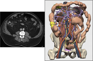 Abdominal-pelvic axial CT image and 3D reconstruction from the same CT scan: 1) Tumor; 2) Possible invasion of retroperitoneal fat; 3) Possible lymphadenopathies.
