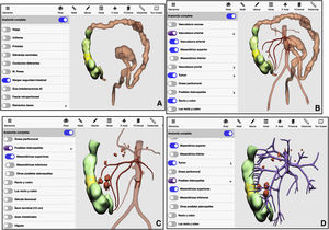 3D-IPR method used to establish surgical strategy in right colon cancer: A) Mathematical delimitation of the intestinal margin 10 cm proximal and distal to the tumor; B) Feeder vessels of the area established in A; C) Location of possible lymphadenopathies in the arterial region of the area established in A; D) Location of possible lymphadenopathies in the venous territory of the area established in A.