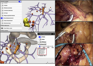 Different surgical steps of the D3 lymphadenectomy procedure, represented with 3D-IPR images and photos from the operation. The 3D-IPR image shows the mathematical identification of the dimensions of the D3 lymph node dissection area. The surgical photograms demonstrate the dissection of this area. 1) Area of the D3 lymphadenectomy; 2) Ileocolic vessels; Red square: dimensions of the volume, upper length and width of the D3 lymphadenectomy area.