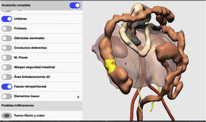 Demonstration of the reconstruction of the retroperitoneal fascia using 3D-IPR; 1) Retroperitoneal fascia.