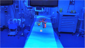 Planning hepatic surgery. 3D model of hepatic metastasis in segment VII viewed in its natural position with AR in the operating room.