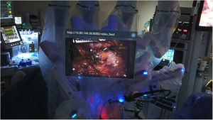 Substitution of physical elements for virtual ones. Virtual screen with the image of the surgery over the robotic arms.