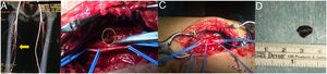 A) AngioCT: metallic body 7.5 mm in right superficial femoral artery. B) Removal of the metallic body and thrombectomy. C) preparation of proximal and distal end artery. D) Metallic Splinter.