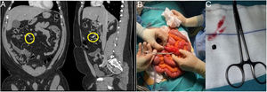 A) CT: projectile in mesenteric cavity. B) Perforation of the antimesenteric border. C) Metallic splinter.