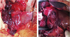 Duodenal hematoma secondary to neoplasm of the head of the pancreas: (A) Hemoperitoneum and hematoma dissecting the seromuscular duodenal, open at the superior cavity; (B) Appearance after evacuation of the hematoma and prior to the start of the pancreaticoduodenectomy.