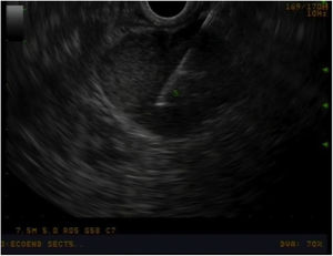Endoscopic ultrasound of a lymphadenopathy suspected of malignancy from which a needle biopsy was taken.