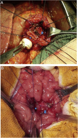 Image from the moment of reimplantation of the bile duct (*) and the main pancreatic duct (#), after transduodenal ampullectomy: (A) before reimplanting the biliary and pancreatic duct; and (B) once the biliary and pancreatic anastomoses were completed.