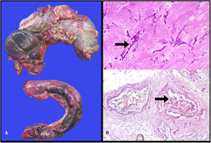 A- Righ colectomy with cecal necrosis and obliterated ileocolic vessels, and ileum ischemia. B-Abundant fungal structures within vascular lumen.