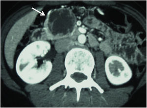 Axial abdominal CT image in the arterial phase showing evidence of a lesion compatible with cystic NET (arrow) in the uncinate process of the pancreas (Case 1).