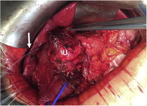 Detailed intraoperative view (case 7) showing the cholangiography catheter (arrow) for localization of the intrapancreatic distal bile duct and duodenal traction (blue vessel-loop). U: uncinated.