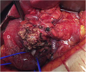 Detailed intraoperative image (Case 7) of the resection site after excision of the uncinate process. D: duodenum; SMV: superior mesenteric vein; RM: resection margin.