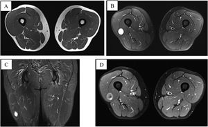 MRI of thighs: (A) intensity similar to the musculature in T1 sequences, without fat suppression; (B and C) high intensity in PD sequences with fat suppression showing cranial and caudal halo; (D) peripheral heterogenous moderate-intense enhancement with hypointense nodular central area and no enhancement in T1 post-contrast.