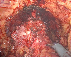Image after cystoprostatectomy before division of the urethra.