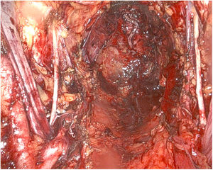 Image of the pelvis after exenteration with preservation of the anal sphincter and pelvic lymphadenectomy.