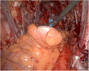 Image of the exenteration with reconstruction of the digestive tract.