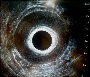 Axial view of the endoanal ultrasound.