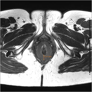 Axial view in T2 sequence with fat saturation.