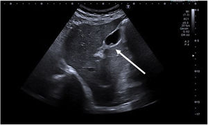 Ultrasound image of the cholesterol polyp in the gallbladder (arrow).