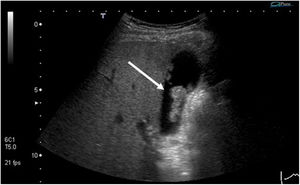 Ultrasound image compatible with a large gallbladder polyp — The histological result was gallbladder adenoma (arrow).