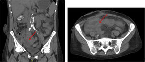 Abdominal-pelvic CT angiogram with intravenous contrast, coronal and sagittal images. Inflammatory phlegmon is seen in RIF (red arrow) in the region of the pancreatic graft, with no vascular alterations or contrast extravasation in the area.