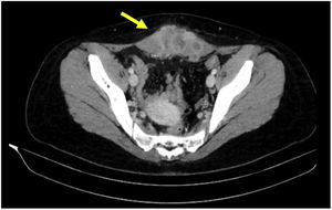 Axial abdominal-pelvic CT scan with intravenous contrast revealing a solid infraumbilical lesion (8 × 8 × 4 cm) occupying both rectus muscles with signs of local invasion, suggestive of a desmoid tumor (yellow arrow); likewise, urachal remnant connecting the umbilicus to the bladder is observed.